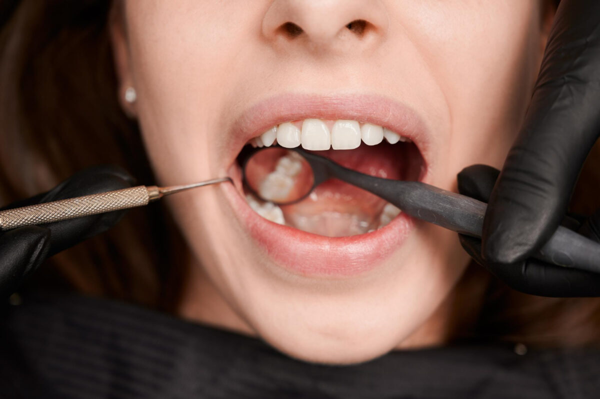 Zbliżenie na dentystę badającego zęby pacjenta za pomocą narzędzi dentystycznych. Usta pacjenta są otwarte, ukazując czyste, białe zęby, podczas gdy dentysta używa lusterka i sondy dentystycznej w czarnych rękawiczkach.